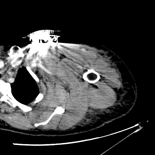 File:Axillary arterial pseudoaneurysm (Radiopaedia 24925-25195 A 5).jpg