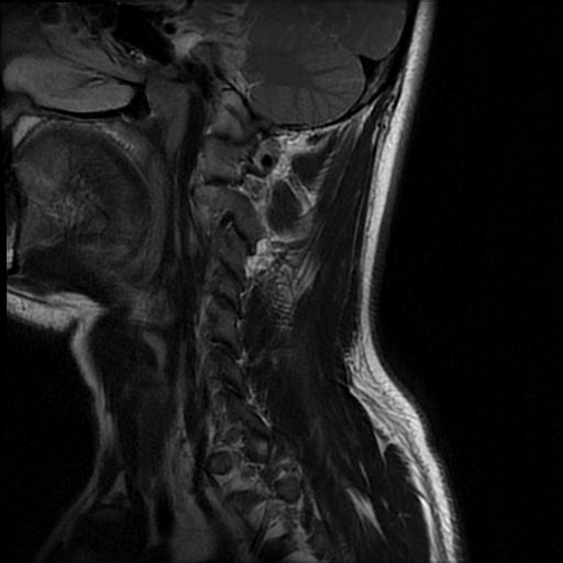 File:Axis fracture - MRI (Radiopaedia 71925-82375 Sagittal T2 9).jpg