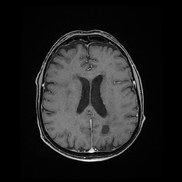 File:Balo concentric sclerosis (Radiopaedia 53875-59982 Axial LAVA C+ 164).jpg