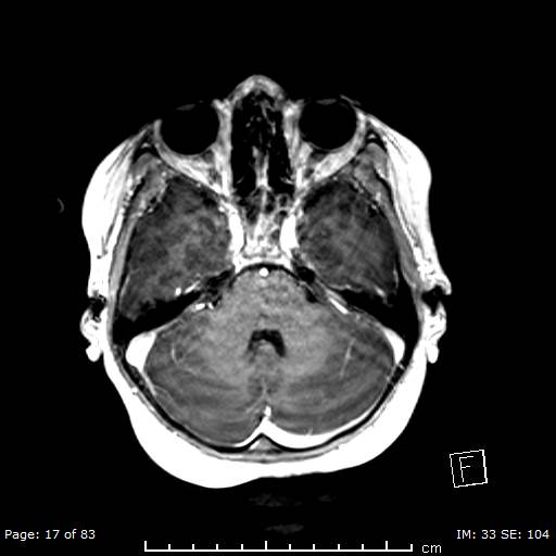 Balo concentric sclerosis (Radiopaedia 61637-69636 Axial T1 C+ 17).jpg