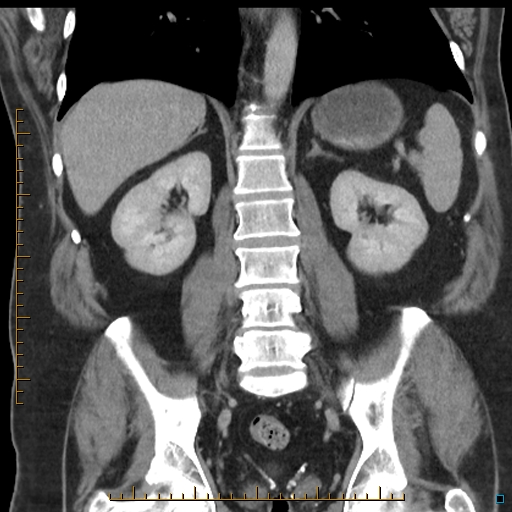 File:Bariatric balloon causing gastric outlet obstruction (Radiopaedia 54449-60672 B 40).jpg