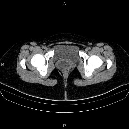 Bartholin gland cyst (Radiopaedia 62635-70930 Axial non-contrast 73).jpg