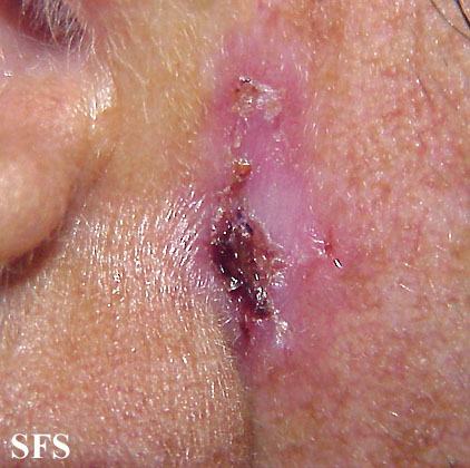 Basal Cell Carcinoma (Dermatology Atlas 114).jpg