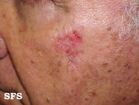 Basal Cell Carcinoma (Dermatology Atlas 23).jpg