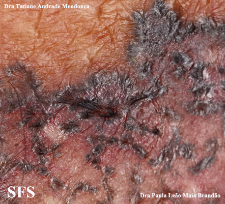 Basal Cell Carcinoma (Dermatology Atlas 233).jpg