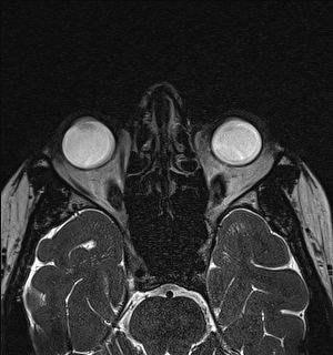 Basal cell carcinoma - nasal region (Radiopaedia 70292-80365 Axial Gradient Echo 68).jpg