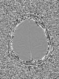 Base of skull chondrosarcoma (Radiopaedia 30410-31070 Axial SWI Phase 48).jpg