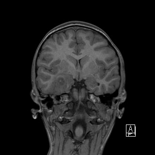 Base of skull rhabdomyosarcoma (Radiopaedia 32196-33142 Coronal T1 22).jpg