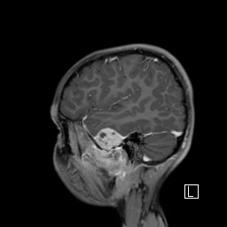 Base of skull rhabdomyosarcoma (Radiopaedia 32196-33142 J 16).jpg