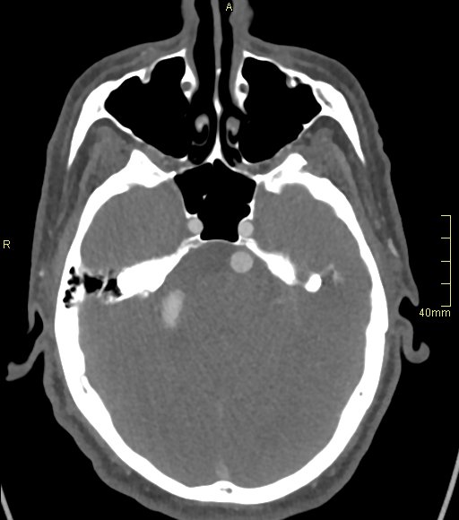 Basilar artery aneurysm (Radiopaedia 56261-62932 A 60).jpg
