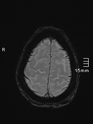 Basilar artery perforator aneurysm (Radiopaedia 82455-99523 Axial SWI 59).jpg