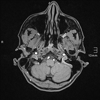 Basilar artery perforator aneurysm (Radiopaedia 82455-99523 F 6).jpg
