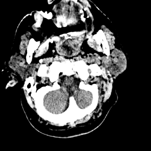 Basilar artery thrombosis (Radiopaedia 53351-59333 Axial non-contrast 18).jpg