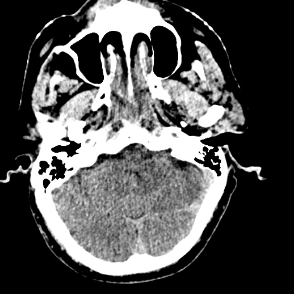 File:Basilar artery thrombosis (Radiopaedia 53351-59333 Axial non-contrast 36).jpg