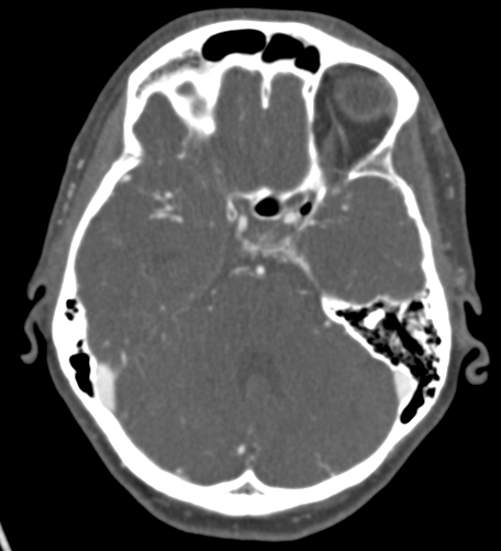Basilar tip aneurysm with coiling (Radiopaedia 53912-60086 A 50).jpg