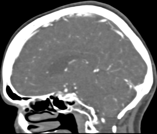 Basilar tip aneurysm with coiling (Radiopaedia 53912-60086 C 74).jpg