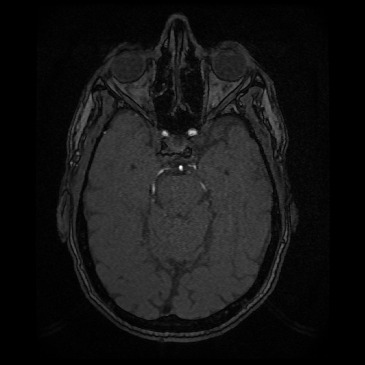 Basilar top and left middle cerebral artery aneurysm (Radiopaedia 61965-70031 Axial MRA 55).jpg