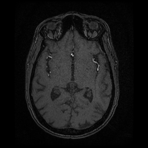 Basilar top and left middle cerebral artery aneurysm (Radiopaedia 61965-70031 Axial MRA 79).jpg