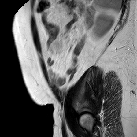 File:Benign seromucinous cystadenoma of the ovary (Radiopaedia 71065-81300 Sagittal T2 1).jpg