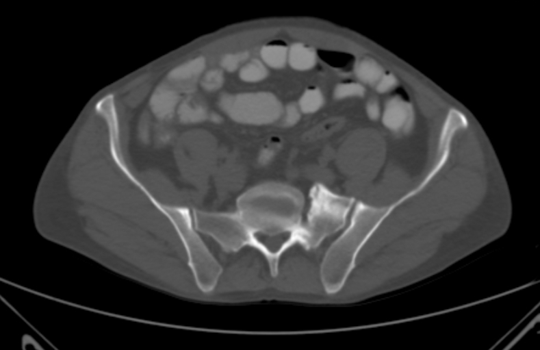 File:Bertolotti syndrome (Radiopaedia 58974-66235 Axial bone window 7).jpg
