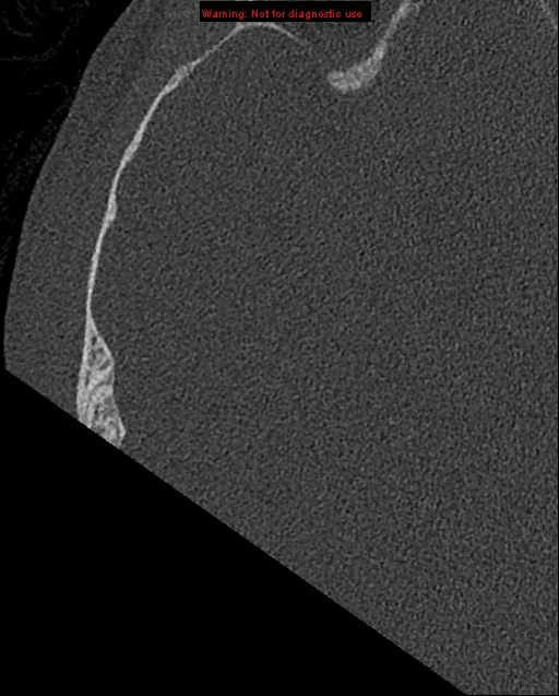 Bezold abscess (Radiopaedia 21645-21605 bone window 13).jpg