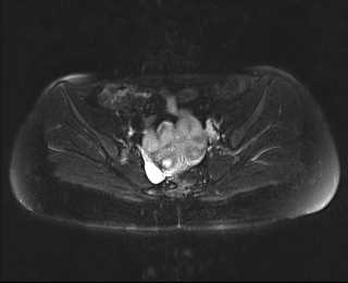 File:Bicornuate bicollis uterus (Radiopaedia 61626-69616 Axial PD fat sat 15).jpg