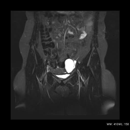 File:Bicornuate uterus- on MRI (Radiopaedia 49206-54297 Coronal STIR 4).jpg