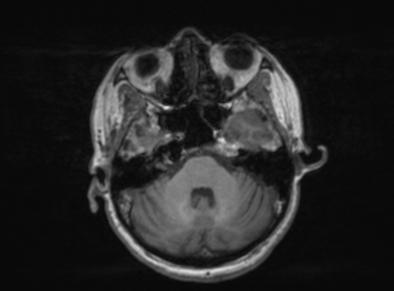 Bilateral PCA territory infarction - different ages (Radiopaedia 46200-51784 Axial T1 301).jpg