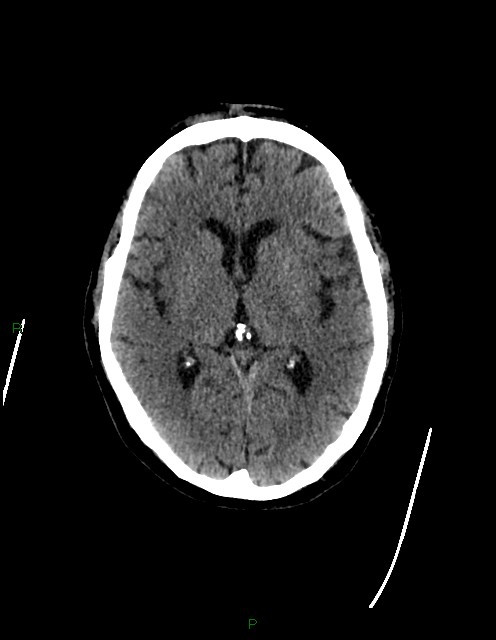 Bilateral acute middle cerebral artery territory infarcts (Radiopaedia 77319-89401 Axial non-contrast 43).jpg