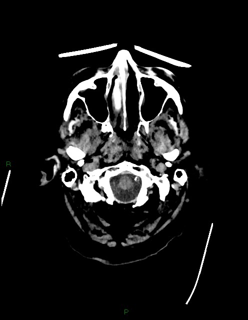 Bilateral acute middle cerebral artery territory infarcts (Radiopaedia 77319-89401 Axial non-contrast 5).jpg