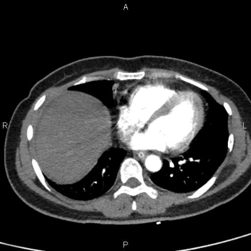 Bilateral adrenal gland hyperenhancement in pancreatitis (Radiopaedia 86642-102753 B 6).jpg