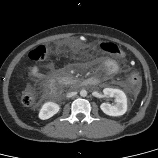 Bilateral adrenal gland hyperenhancement in pancreatitis (Radiopaedia 86642-102753 E 53).jpg