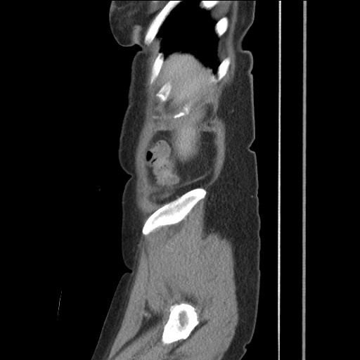 File:Bilateral adrenal granulocytic sarcomas (chloromas) (Radiopaedia 78375-91007 C 26).jpg