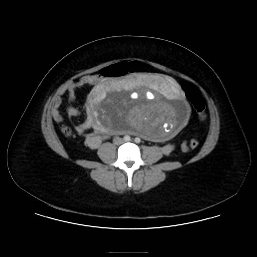 Bilateral adrenal thrombosis (Radiopaedia 58182-65256 A 45).jpg