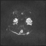 Bilateral basal ganglia and thalamic T1 hyperintensities (Radiopaedia 19764-19802 Axial DWI 22).jpg