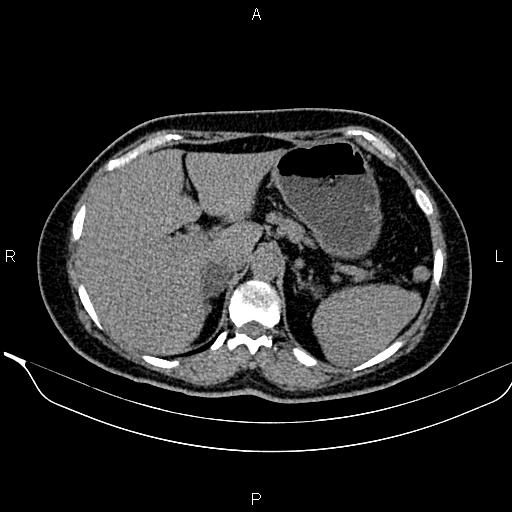 Bilateral benign adrenal adenomas (Radiopaedia 86912-103124 Axial non-contrast 31).jpg