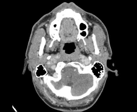 Bilateral carotid body tumors (Radiopaedia 61841-69870 Axial Post contrast 14).jpg