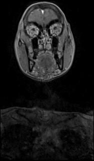 File:Bilateral carotid body tumors and right glomus jugulare tumor (Radiopaedia 20024-20060 MRA 1).jpg