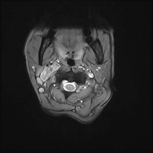 File:Bilateral carotid body tumors and right jugular paraganglioma (Radiopaedia 20024-20060 Axial 68).jpg