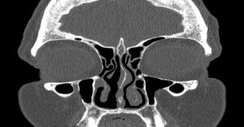 File:Bilateral ectopic infraorbital nerves (Radiopaedia 49006-54084 Coronal 54).png