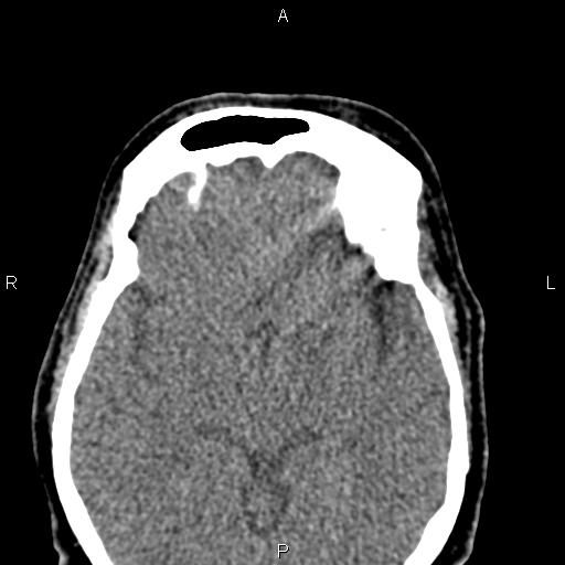 Bilateral enlargement of lacrimal glands - sarcoidosis (Radiopaedia 62627-70921 Axial non-contrast 68).jpg