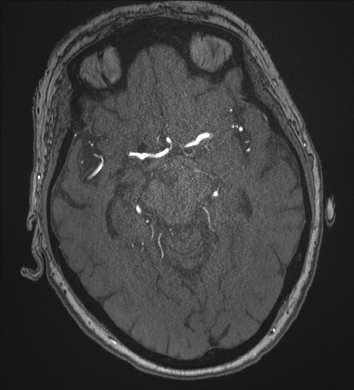Bilateral fetal posterior communicating arteries (Radiopaedia 41286-44102 Axial MRA 89).png