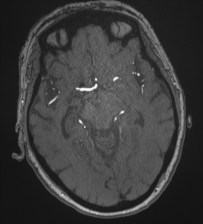 Bilateral fetal posterior communicating arteries (Radiopaedia 41286-44102 Axial MRA 91).png