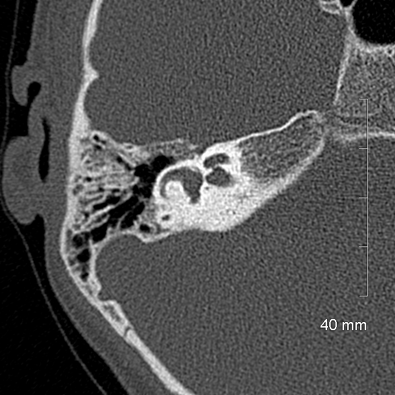 Bilateral grommets (Radiopaedia 47710-52404 Axial bone window 42).jpg
