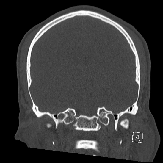 Bilateral occipital condyle fracture (type 2) (Radiopaedia 87675-104089 Coronal bone window 67).jpg