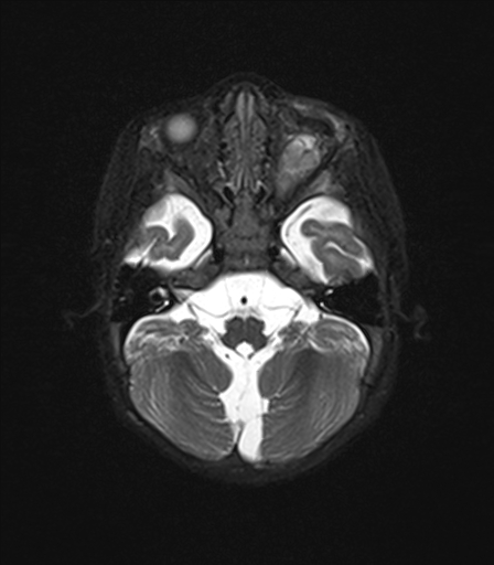 File:Bilateral optic pathway gliomas (Radiopaedia 40013-42514 Axial T2 fat sat 2).jpg