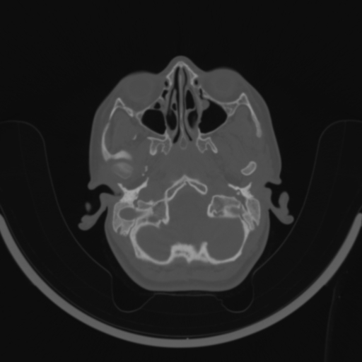 Bilateral otosclerosis (Radiopaedia 57237-64157 C 18).jpg