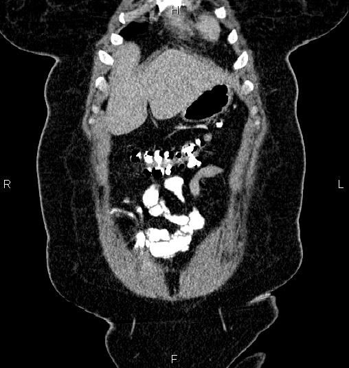 Bilateral ovarian dermoid cysts (Radiopaedia 85785-101603 C 3).jpg