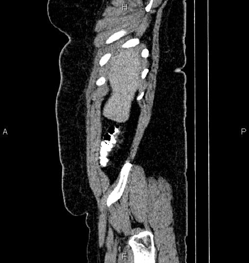 Bilateral ovarian dermoid cysts (Radiopaedia 85785-101603 D 3).jpg
