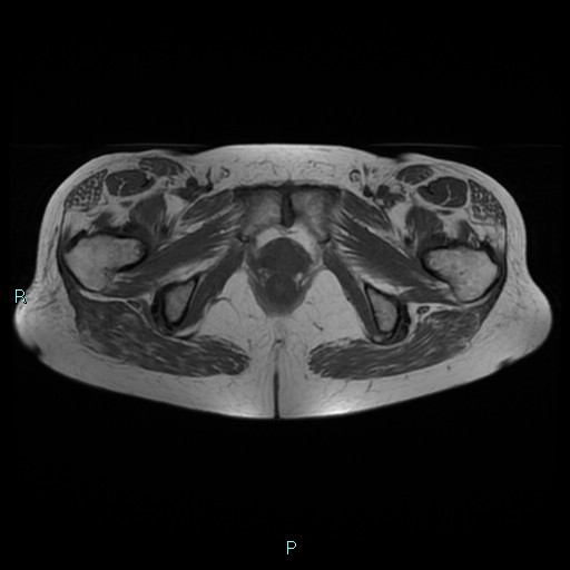 File:Bilateral ovarian fibroma (Radiopaedia 44568-48293 Axial T1 26).jpg